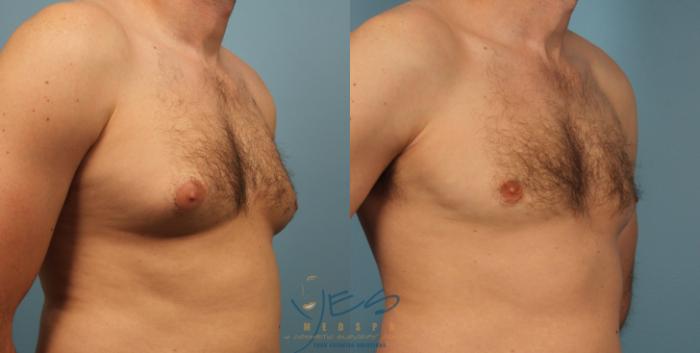 Before & After Male Breast Reduction Case 457 Right Oblique View in Vancouver, BC