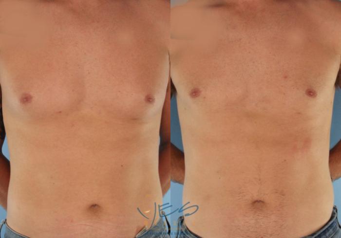 Before & After Male Breast Reduction Case 580 Front View in Vancouver, BC