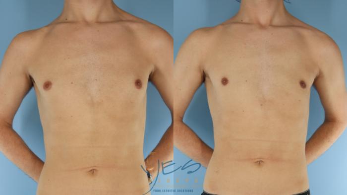 Before & After Male Breast Reduction Case 599 Front View in Vancouver, BC