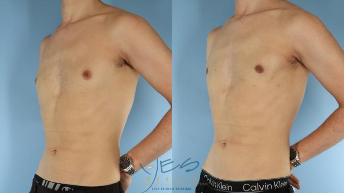 Before & After Male Breast Reduction Case 599 Left Oblique View in Vancouver, BC