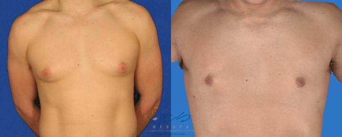 Before & After Male Breast Reduction Case 85 View #1 View in Vancouver, BC