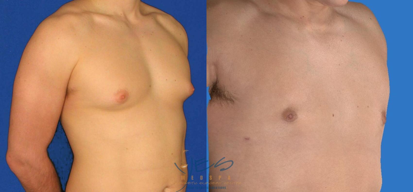 Before & After Male Breast Reduction Case 85 View #2 View in Vancouver, BC