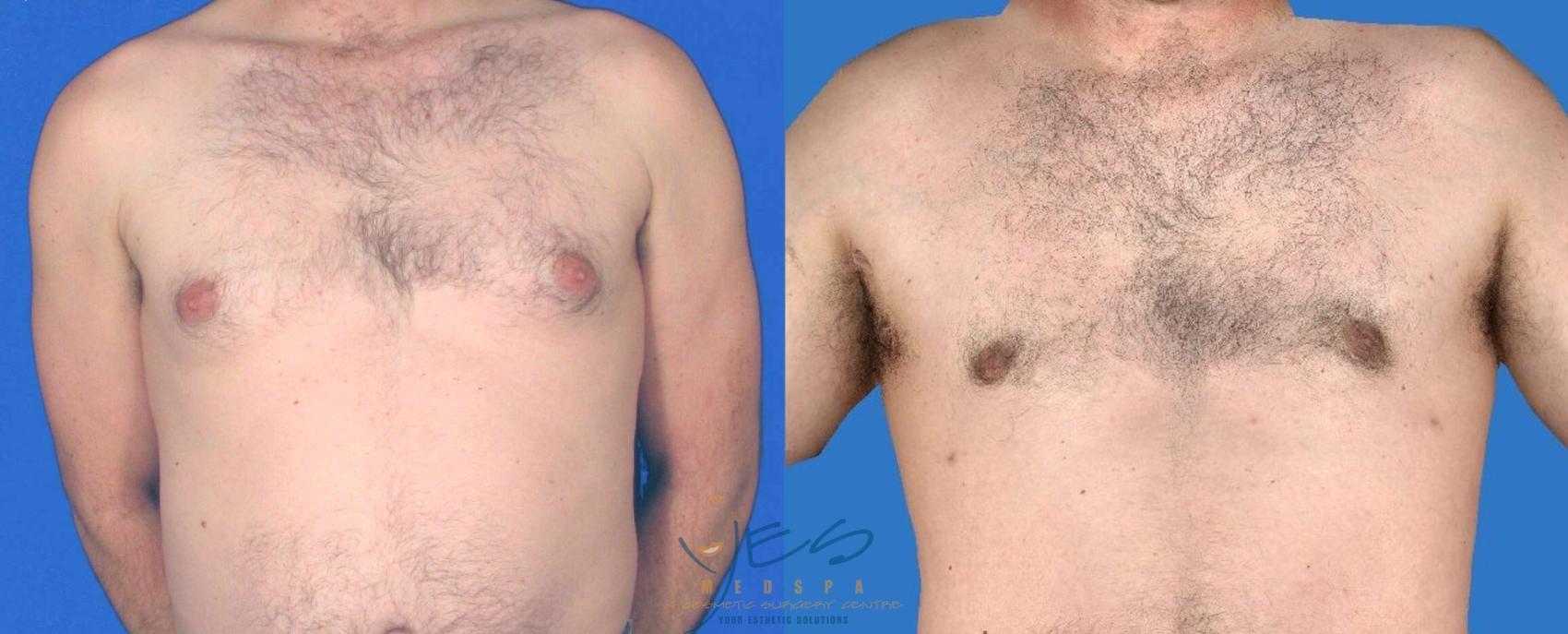 Before & After Male Breast Reduction Case 86 View 1 View in Vancouver, BC