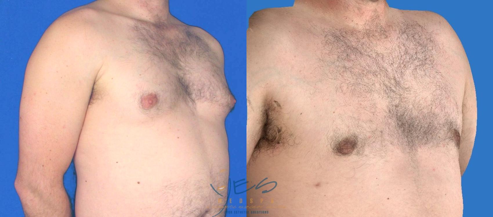 Before & After Male Breast Reduction Case 86 View #2 View in Vancouver, BC