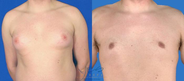 Before & After Male Breast Reduction Case 87 View #1 View in Vancouver, BC
