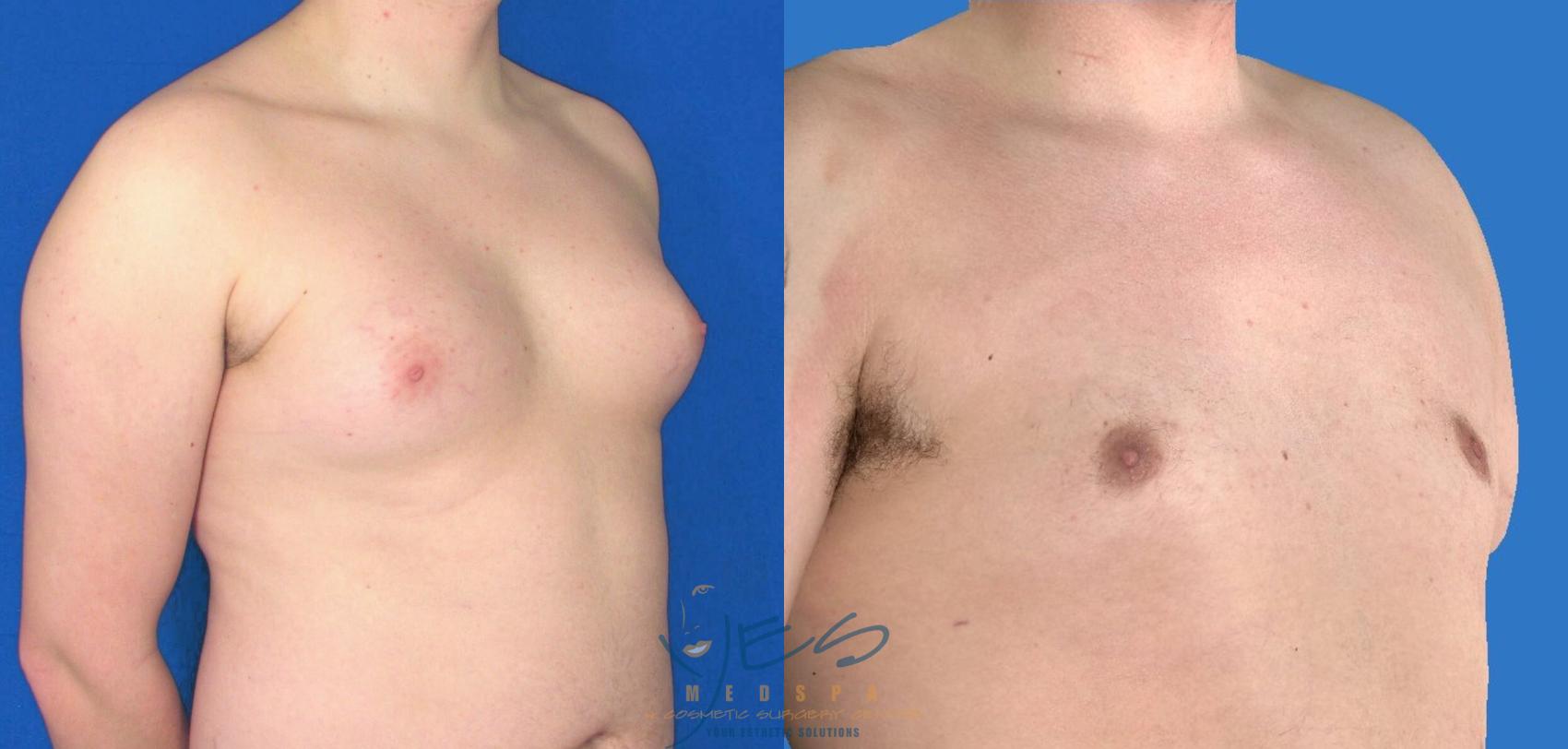 Before & After Male Breast Reduction Case 87 View #2 View in Vancouver, BC