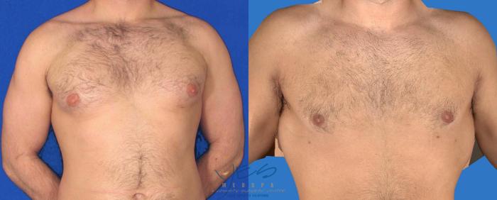 Before & After Male Breast Reduction Case 88 View #1 View in Vancouver, BC