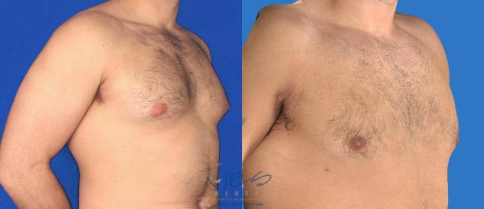 Before & After Male Breast Reduction Case 88 View #2 View in Vancouver, BC