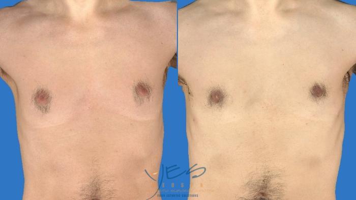 Before & After Male Breast Reduction Case 96 Front View in Vancouver, BC