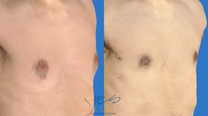 Before & After Male Breast Reduction Case 96 Right Oblique View in Vancouver, BC