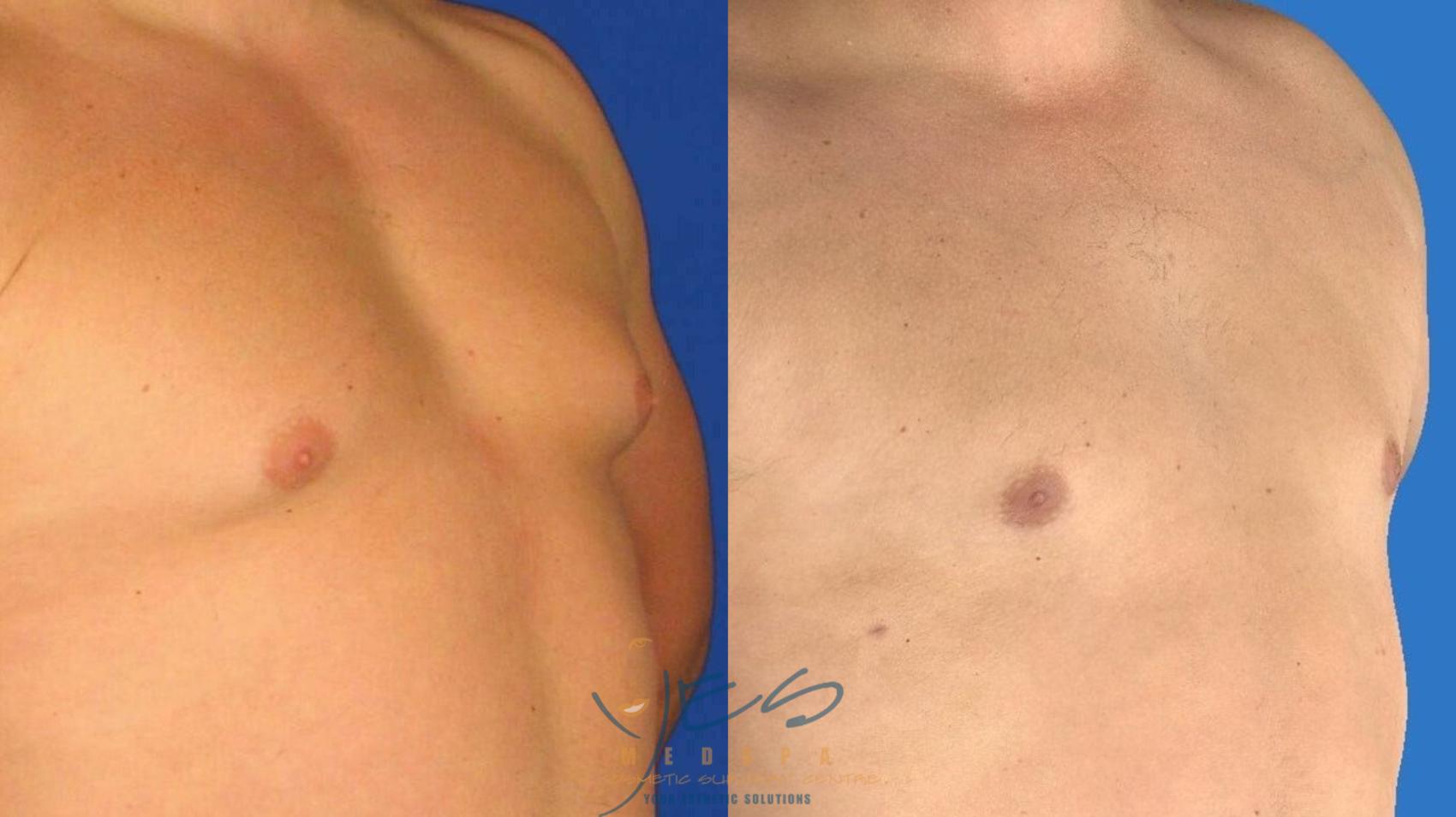Before & After Male Breast Reduction Case 97 Right Oblique View in Vancouver, BC