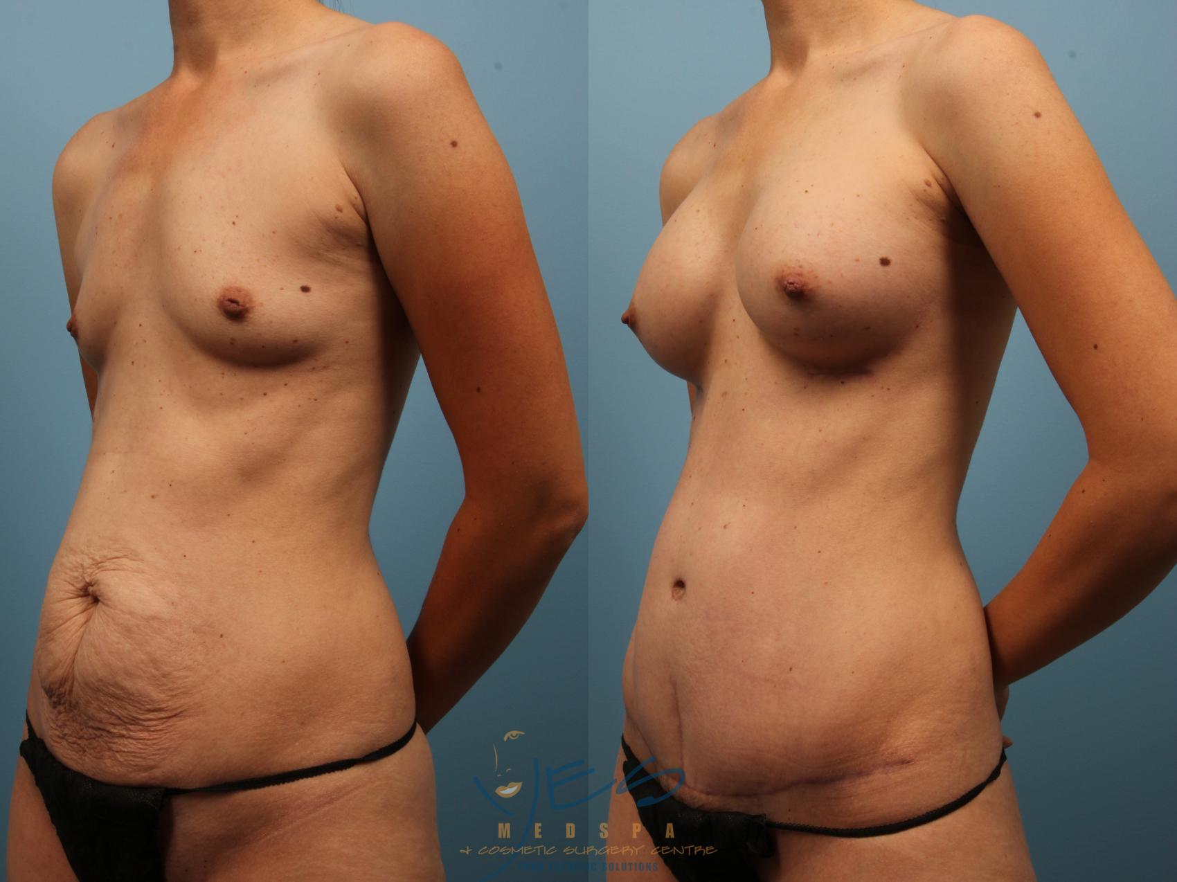 Before & After Mommy Makeover Case 146 Left Oblique View in Vancouver, BC