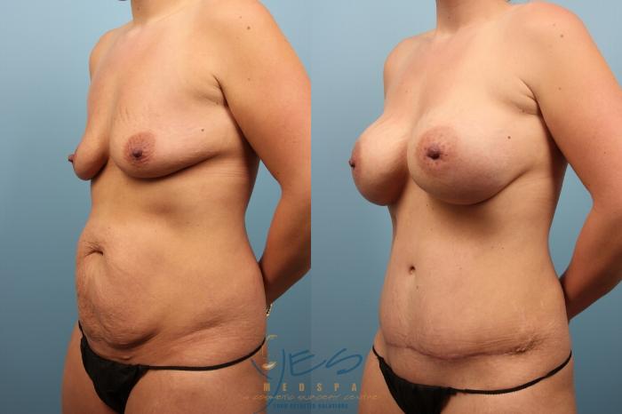 Before & After Mommy Makeover Case 169 Left Oblique View in Vancouver, BC