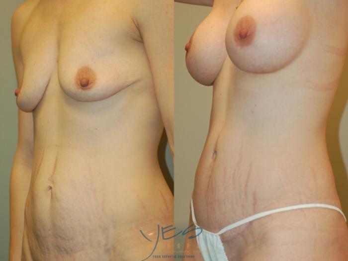 Before & After Mommy Makeover Case 269 Left Oblique View in Vancouver, BC