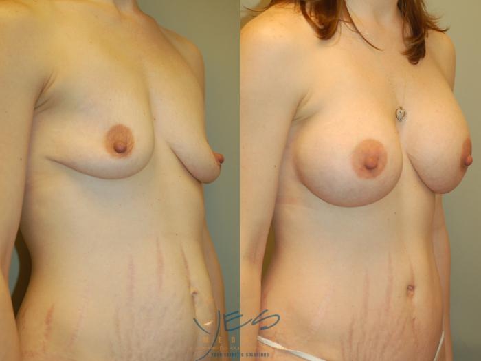 Before & After Mommy Makeover Case 269 Right Oblique View in Vancouver, BC
