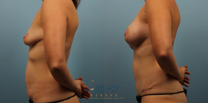 Before & After Breast Augmentation Case 280 Left Side View in Vancouver, BC