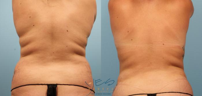Before & After Liposuction Case 368 Back View in Vancouver, BC