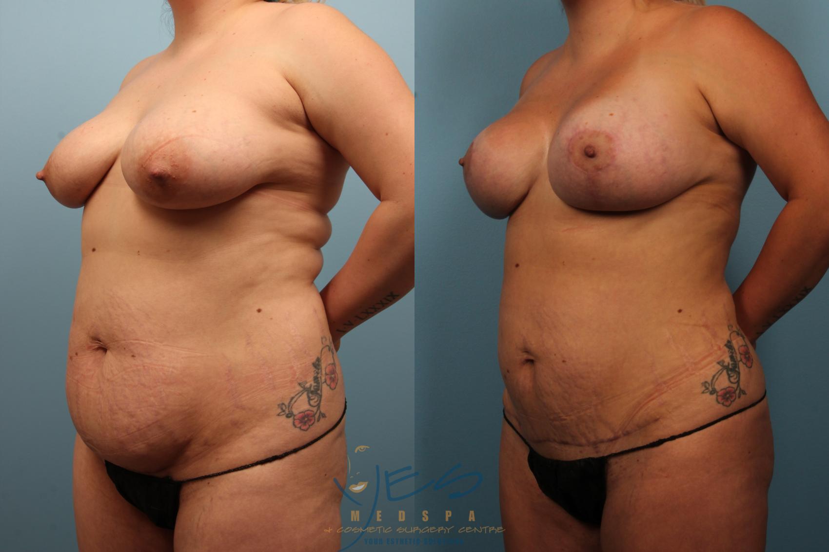 Before & After Tummy Tuck Case 368 Left Oblique View in Vancouver, BC