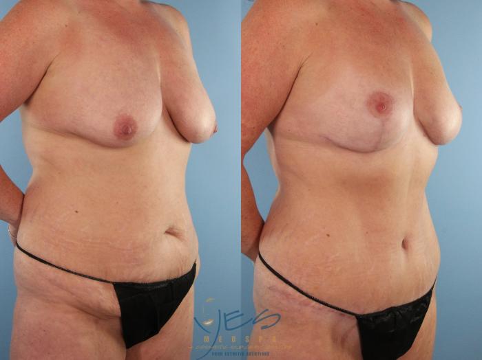 Before & After Mommy Makeover Case 491 Right Oblique View in Vancouver, BC