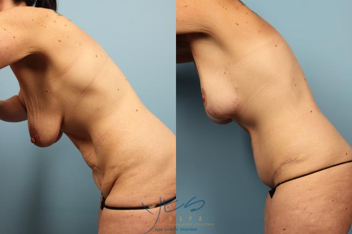 Before & After Mommy Makeover Case 500 Divers Pose View in Vancouver, BC