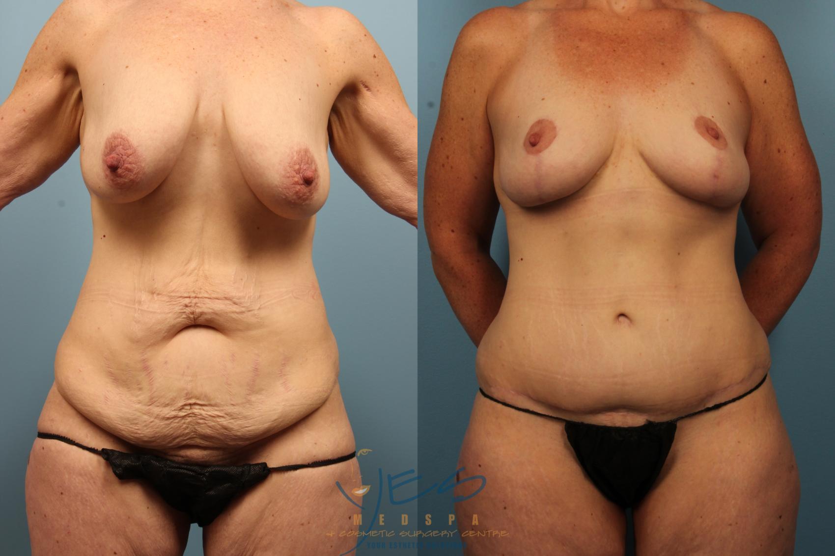 Before & After Tummy Tuck Case 500 Front View in Vancouver, BC