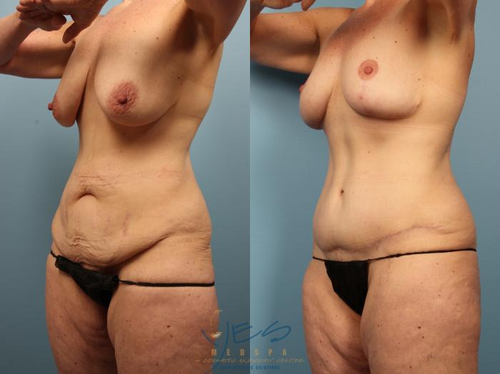 Before & After Tummy Tuck Case 500 Left Oblique View in Vancouver, BC