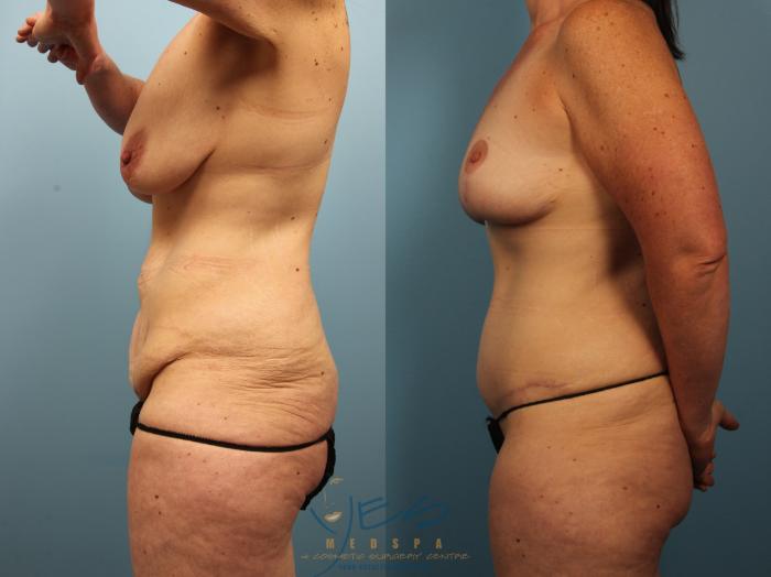 Before & After Tummy Tuck Case 500 Left Side View in Vancouver, BC