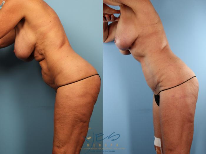 Before & After Tummy Tuck Case 502 Divers Pose View in Vancouver, BC