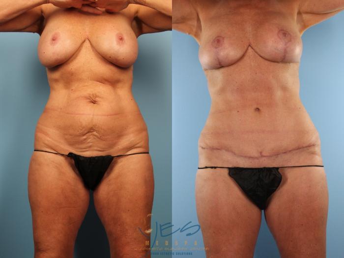 Before & After Revision Breast Surgery Case 502 Front - Lower scar View in Vancouver, BC