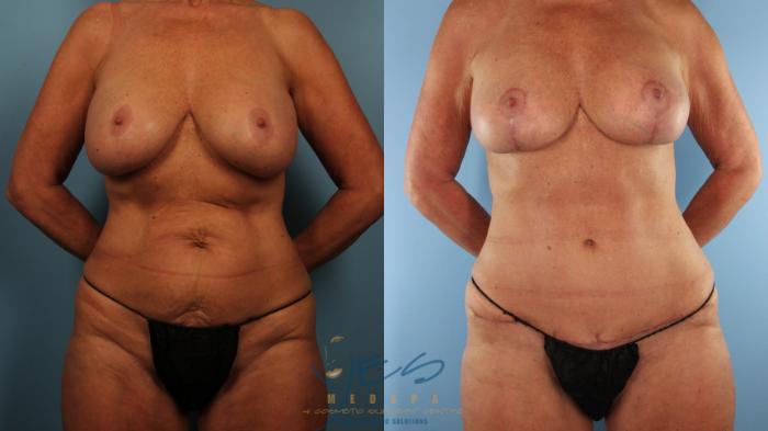 Before & After Revision Breast Surgery Case 502 Front View in Vancouver, BC