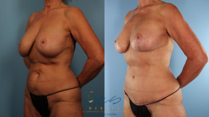 Before & After Mommy Makeover Case 502 Left Oblique View in Vancouver, BC