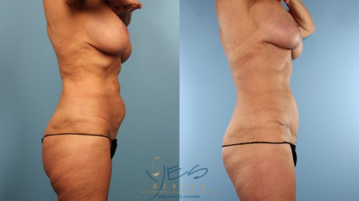 Before & After Tummy Tuck Case 502 Left Side View in Vancouver, BC
