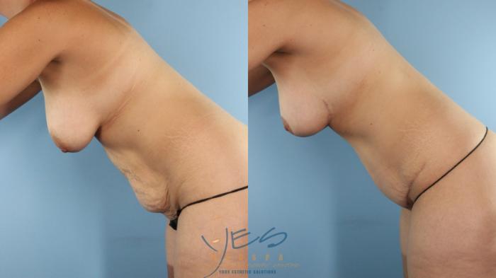 Before & After Breast Lift Case 518 Diver's pose View in Vancouver, BC
