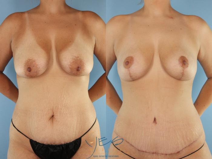 Before & After Breast Lift Case 518 Front View in Vancouver, BC