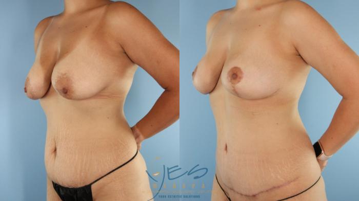 Before & After Tummy Tuck Case 518 Left Oblique View in Vancouver, BC