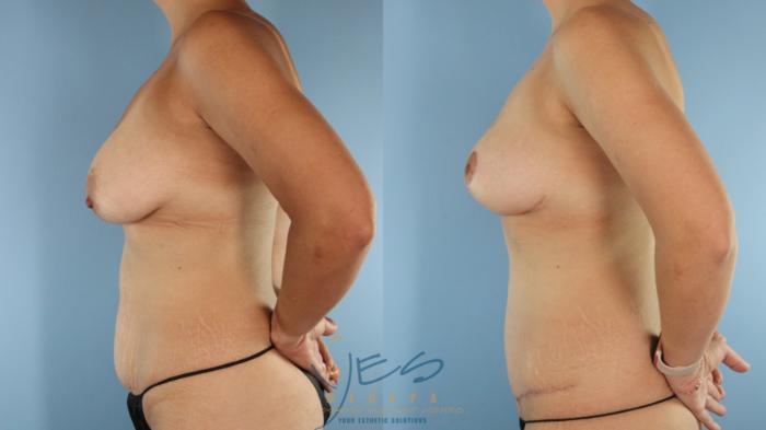Before & After Tummy Tuck Case 518 Left Side View in Vancouver, BC
