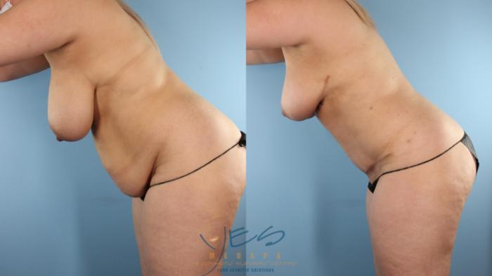 Before & After Mommy Makeover Case 583 Diver's pose View in Vancouver, BC