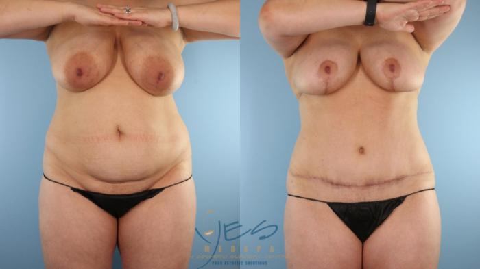 Before & After Mommy Makeover Case 583 Front View in Vancouver, BC
