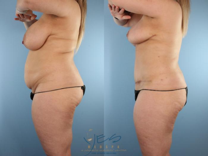 Before & After Mommy Makeover Case 583 Left Side View in Vancouver, BC