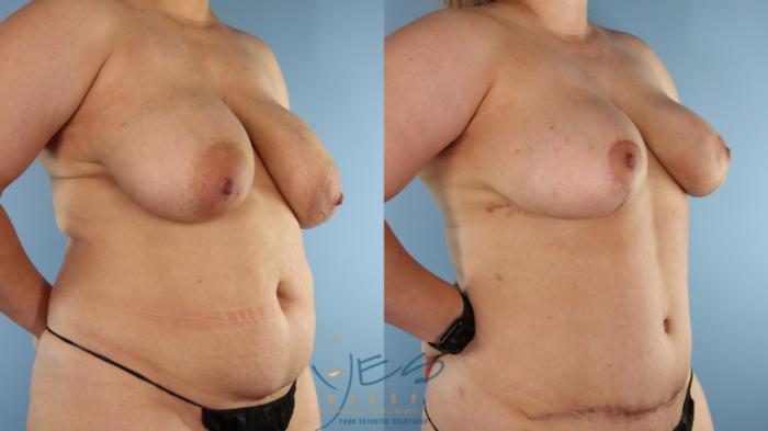 Before & After Mommy Makeover Case 583 Right Oblique View in Vancouver, BC