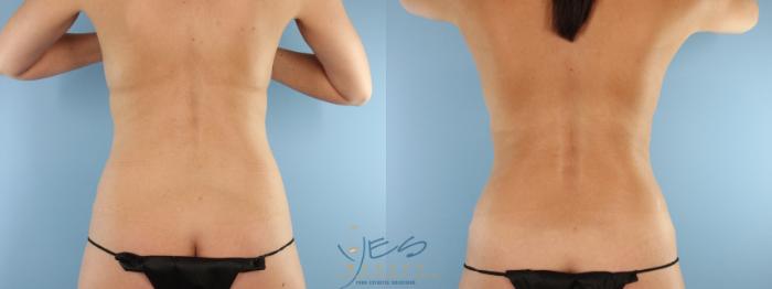 Before & After Mommy Makeover Case 594 Back View in Vancouver, BC