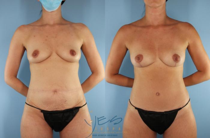 Before & After Mommy Makeover Case 594 Front - Breast View in Vancouver, BC