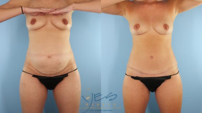 Before & After Mommy Makeover Case 594 Front View in Vancouver, BC
