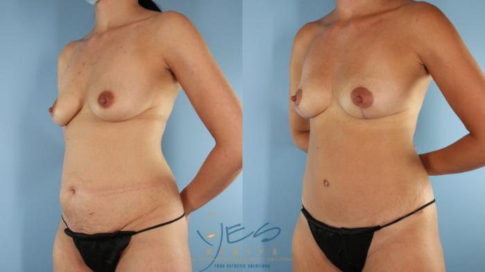 Before & After Mommy Makeover Case 594 Left Oblique View in Vancouver, BC