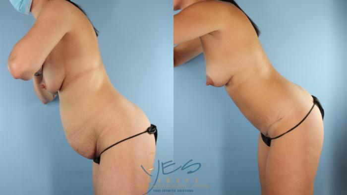 Before & After Mommy Makeover Case 594 Left Side View in Vancouver, BC