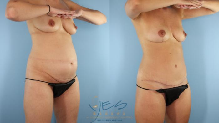 Before & After Mommy Makeover Case 594 Right Oblique View in Vancouver, BC