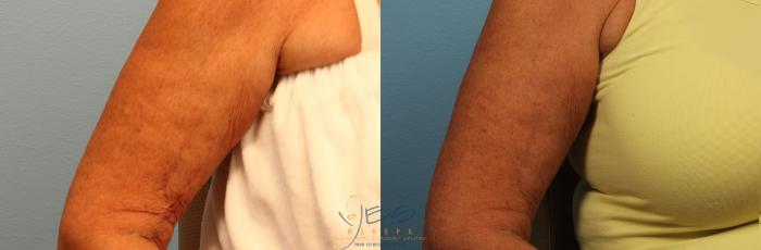 Before & After Evolve Tite / Venus BodyFx Case 344 Right Side View in Vancouver, BC