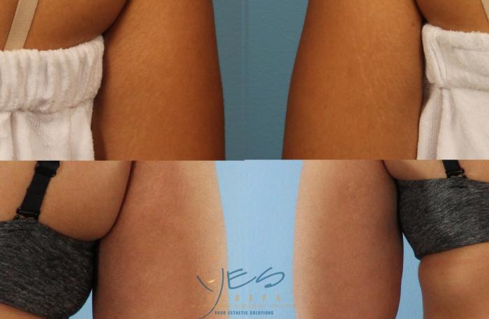 Before & After Morpheus8 Case 385 Right Oblique View in Vancouver, BC