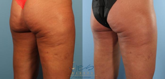 Before & After Morpheus8 Case 393 Right Oblique View in Vancouver, BC