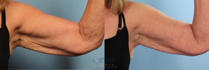 Before & After Evolve Tite / Venus BodyFx Case 410 Front - 90 Degree - Left View in Vancouver, BC